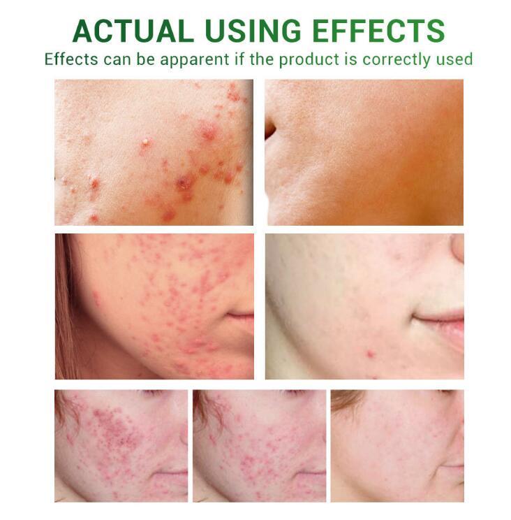 Acne Treatment Serum Facial Repair Oil - BabynBeauty