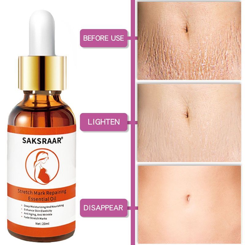 Stretch Mark Remover Essential Oil Care Cream - BabynBeauty